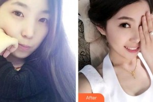 杭州品凱口腔醫(yī)院陳閏香整形價格表附牙齒隱形矯正案例展示