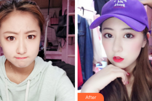 廣州市中西醫(yī)結合醫(yī)院燒傷整形外科劉移峰整形價格表附微針水光案例展示