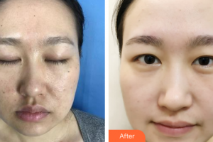 廣州市中西醫(yī)結合醫(yī)院燒傷整形外科林桂清整形價格表附微針美膚案例展示