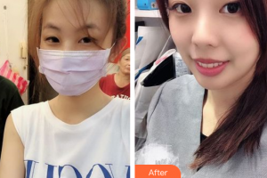 廣州市中西醫(yī)結合醫(yī)院燒傷整形外科黃錦剛整形價格表附光子嫩膚案例展示