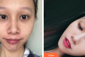 中信惠州醫(yī)院醫(yī)學整形中心楊光成整形價格表附微針美膚案例展示