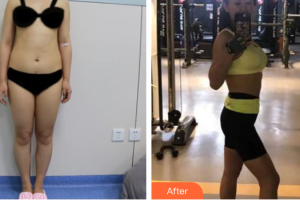 惠州伊麗莎白整形美容醫(yī)院安東顯整形價格表附美體塑形案例展示