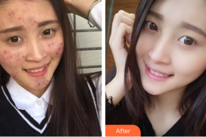 惠州市中心人民醫(yī)院整形燒傷科陳奇鳴整形價格表附紅藍光祛痘案例展示