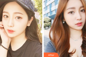 惠州市中心人民醫(yī)院整形燒傷科孟宏整形價(jià)格表附光子嫩膚案例展示