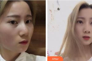 惠州市中心人民醫(yī)院整形燒傷科余林權(quán)整形價(jià)格表附果酸換膚案例展示