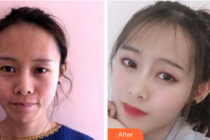 惠州鵬愛(ài)醫(yī)療美容醫(yī)院申濤整形價(jià)格表附埋線提升案例展示