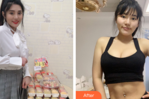 惠州鵬愛醫(yī)療美容醫(yī)院黃華軍整形價格表附全身吸脂案例展示