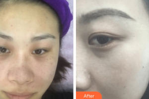 中信惠州醫(yī)院醫(yī)學整形中心柏松整形價格表附超激光美膚+祛斑針案例展示