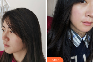 中信惠州醫(yī)院醫(yī)學整形中心何輝整形價格表附果酸換膚案例展示