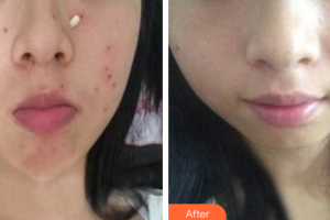 中信惠州醫(yī)院醫(yī)學(xué)整形中心鄒潔整形價(jià)格表附祛斑祛痣案例展示