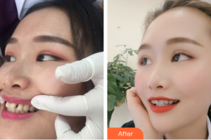 惠州鵬愛(ài)醫(yī)療美容醫(yī)院汪林整形價(jià)格表附隱形托槽矯正案例展示