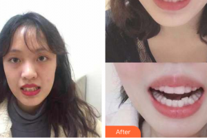 惠州白天鵝口腔醫(yī)院明鑫榮整形價(jià)格表附隱形牙齒矯正案例展示