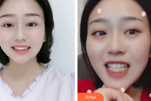 惠州白天鵝口腔醫(yī)院歐雪輝整形價(jià)格表附隱適美全隱形矯正案例展示