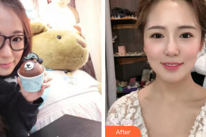 惠州白天鵝口腔醫(yī)院李芃整形價(jià)格表附金屬托槽矯正案例展示