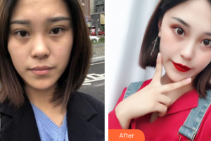 惠州伊麗莎白整形美容醫(yī)院陶溯整形價(jià)格表附超微小氣泡案例展示