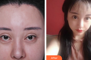 惠州元辰醫(yī)療美容門診部李震整形價(jià)格表附失敗重瞼修復(fù)+上瞼下垂矯正案例展示