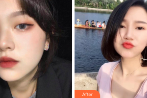 惠州市第六人民醫(yī)院眼科朱月瑩整形價(jià)格表附眼部整形案例展示