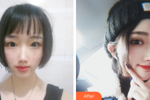 惠州市第一人民醫(yī)院眼科廖潤斌整形價(jià)格表附雙眼皮案例展示