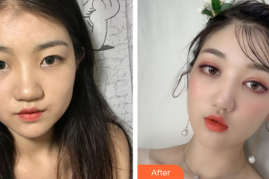 惠州市第一人民醫(yī)院眼科張世華整形價(jià)格表附眼部整形案例展示