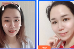 惠州市第一人民醫(yī)院眼科蔡樹泓整形價(jià)格表附眼部綜合案例展示