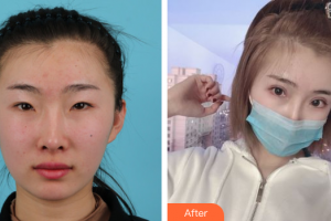 惠州市第六人民醫(yī)院眼科袁釗華整形價(jià)格表附眼部整形案例展示