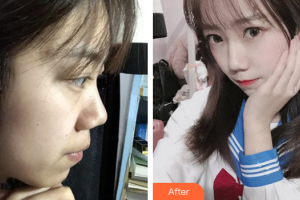 韶關(guān)市粵北人民醫(yī)院整形美容科羅冠雛整形價(jià)格表附微針美塑案例展示