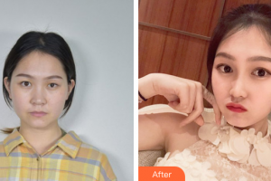 韶關(guān)愛爾眼科醫(yī)院馬麗娜整形價(jià)格表附眼部整形案例展示