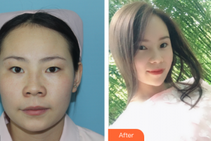 韶關(guān)愛爾眼科醫(yī)院丘韶瓊整形價(jià)格表附精細(xì)切開雙眼皮案例展示