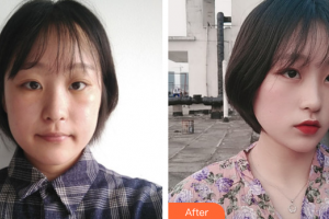 韶關(guān)愛爾眼科醫(yī)院蔡欣整形價(jià)格表附祛眼袋案例展示