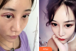 韶關(guān)愛爾眼科醫(yī)院詹衛(wèi)群整形價(jià)格表附切開雙眼皮案例展示