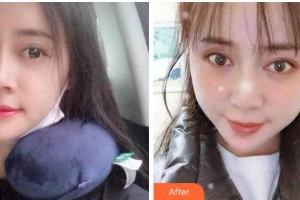 杭州品凱口腔醫(yī)院張衛(wèi)中整形價(jià)格表附自鎖托槽矯正案例展示