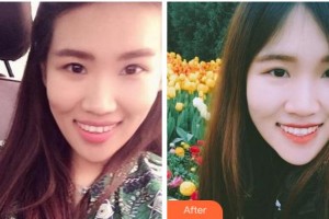 杭州品凱口腔醫(yī)院盧睿敏整形價(jià)格表附牙齒隱形矯正案例展示