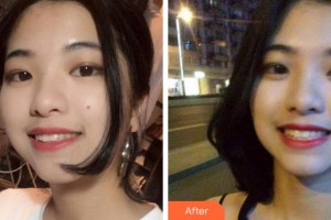 杭州富陽口腔醫(yī)院葉寶定整形價(jià)格表附牙齒隱形矯正案例展示