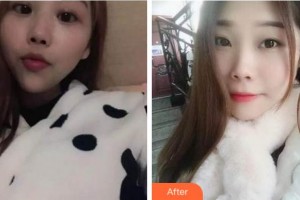 杭州富陽口腔醫(yī)院賈珂整形價(jià)格表附自鎖托槽矯正案例展示