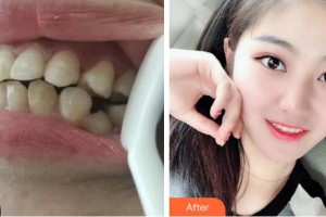 杭州博凡口腔門(mén)診部林毅整形價(jià)格表附金屬托槽矯正案例展示