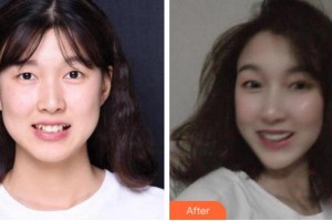 杭州博凡口腔門(mén)診部鄭春穎整形價(jià)格表附牙齒隱形矯正案例展示