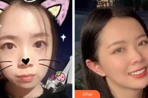 杭州西湖口腔醫(yī)院陳宏軍整形價(jià)格表附金屬托槽矯正案例展示