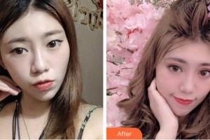 杭州太學(xué)眼科門(mén)診部董媛整形價(jià)格表附眼部綜合案例展示