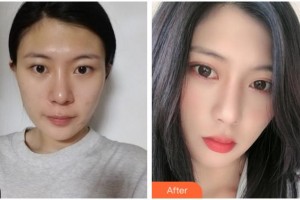 杭州太學(xué)眼科門(mén)診部余威德整形價(jià)格表附眼部綜合案例展示