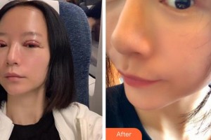 杭州太學(xué)眼科門(mén)診部林丕容整形價(jià)格表附切開(kāi)雙眼皮案例展示