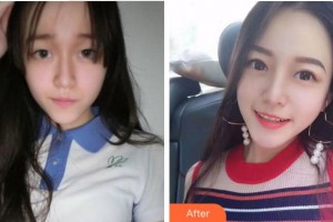 杭州口腔醫(yī)院劉敏整形價(jià)格表附切開(kāi)雙眼皮案例展示