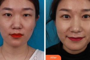 杭州愛(ài)爾眼科醫(yī)院朱雅琴整形價(jià)格表附切開(kāi)雙眼皮案例展示