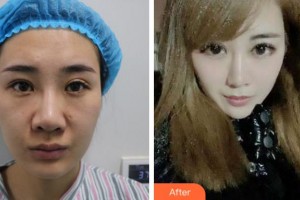 杭州愛(ài)爾眼科醫(yī)院徐亞軍整形價(jià)格表附切開(kāi)雙眼皮案例展示