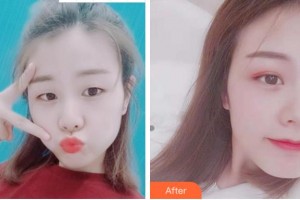 杭州西湖之江眼科醫(yī)院俞阿勇整形價(jià)格表附切開(kāi)雙眼皮案例展示