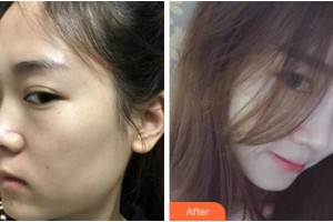 寧波珈禾整形?？漆t(yī)院鮑海萍整形價(jià)格表附膨體隆鼻案例展示