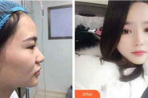 寧波珈禾整形?？漆t(yī)院龔濤整形價(jià)格表附鼻部綜合案例展示