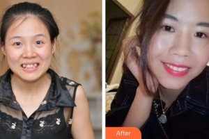 寧波尚麗整形美容醫(yī)院程琳整形價(jià)格表附自鎖托槽矯正案例展示