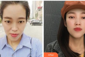 寧波尚麗整形美容醫(yī)院汪蘭主任醫(yī)生整形價(jià)格表附切開雙眼皮案例展示