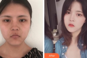 寧波美萊整形美容醫(yī)院馬曉蓬整形價(jià)格表附埋線提升案例展示