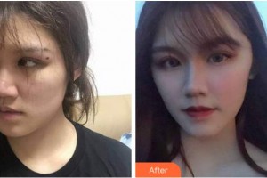 寧波美萊整形美容醫(yī)院朱奎整形價(jià)格表附埋線提升案例展示